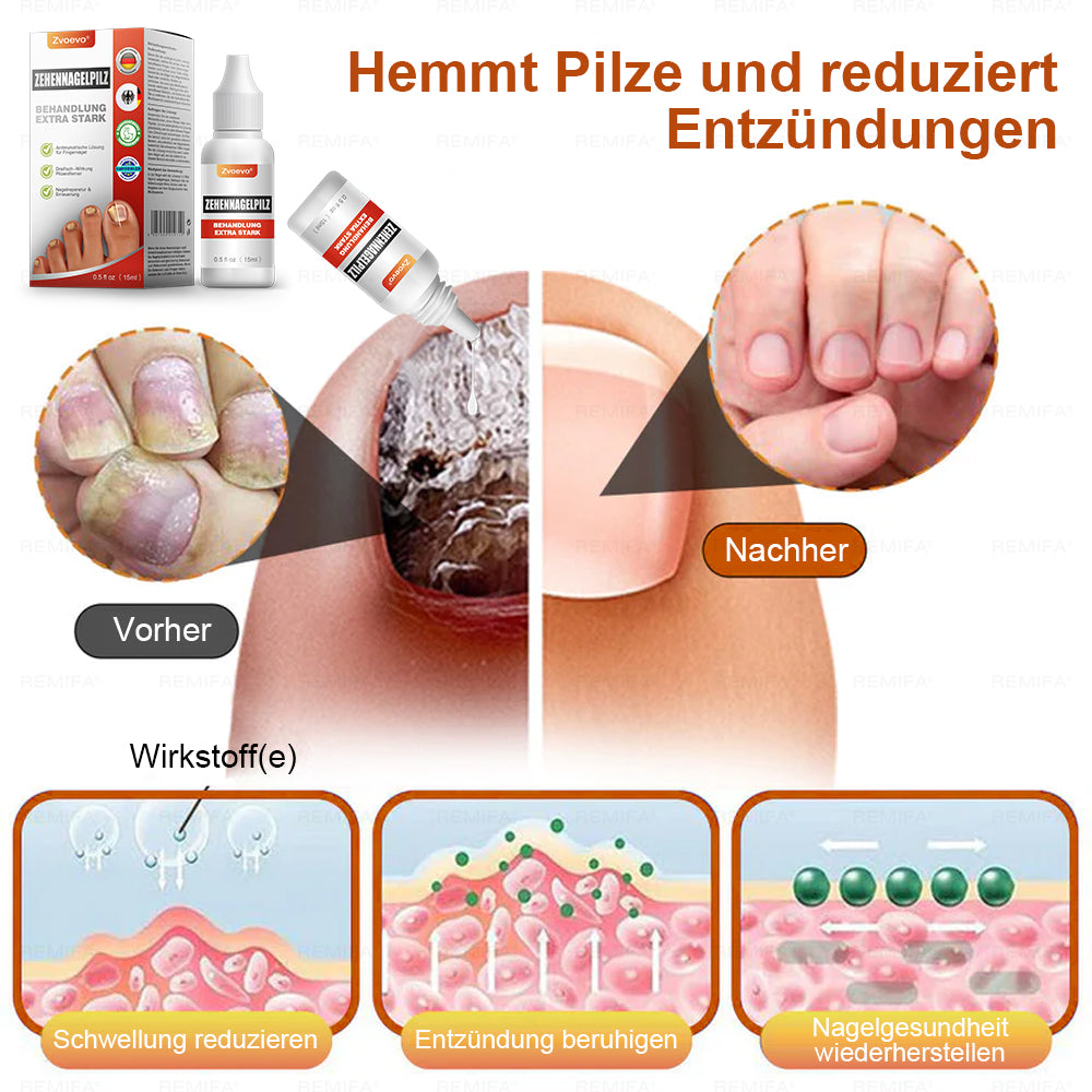✅ Hergestellt und versendet aus Deutschland | Zvoevo® Extra Starkes Nagelpilz-Behandlungsmittel, Antimykotische Lösung für Zehen- oder Fingernägel-up