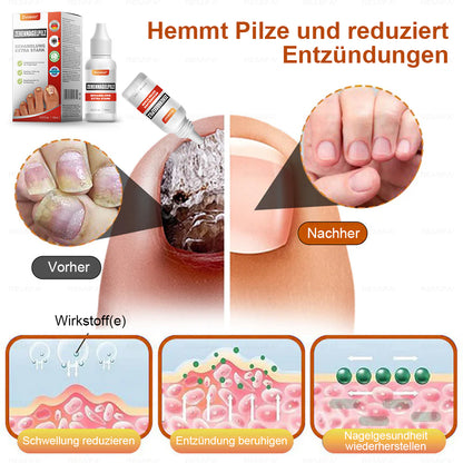 ✅ Hergestellt und versendet aus Deutschland | Zvoevo® Extra Starkes Nagelpilz-Behandlungsmittel, Antimykotische Lösung für Zehen- oder Fingernägel-up