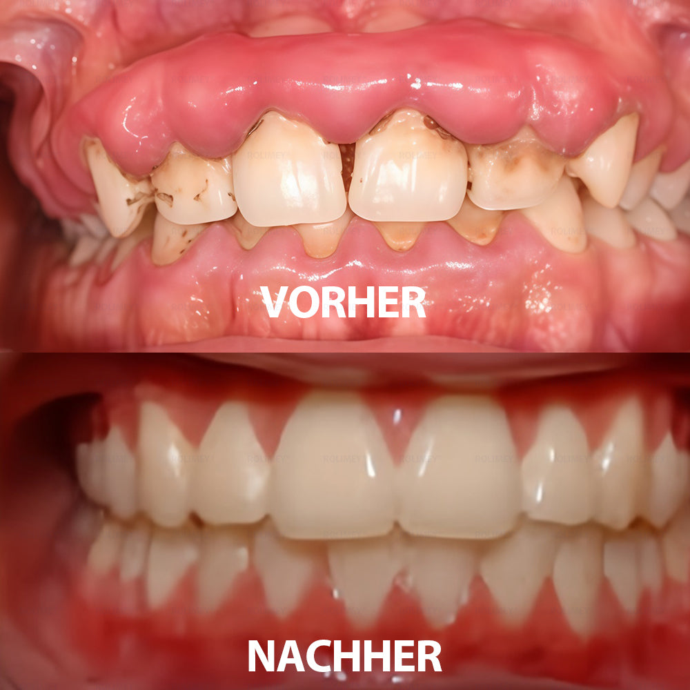 Rolimey® Transforming Growth Factor-β (TGF-β) Mundspülung zur oralen Reparatur